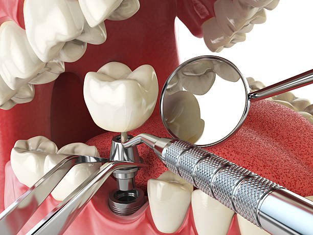 Best Emergency Dentist for Lost Fillings or Crowns in Napervle, IL